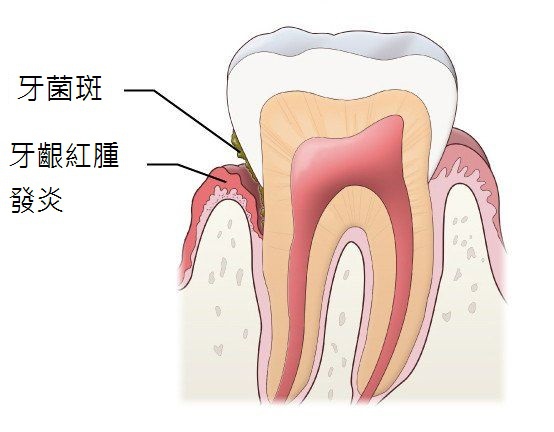 圖一、牙菌斑是造成牙周病主要原因 圖一、牙菌斑是造成牙周病主要原因