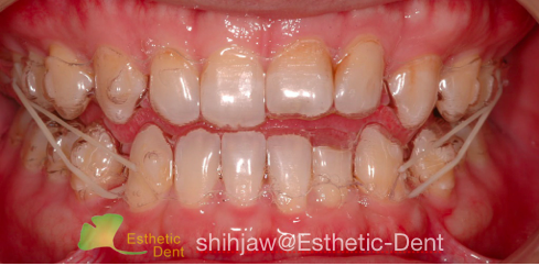 anterior-Xbite-invisalign-mech