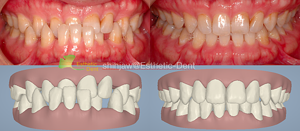 anterior-Xbite-invisalign-result