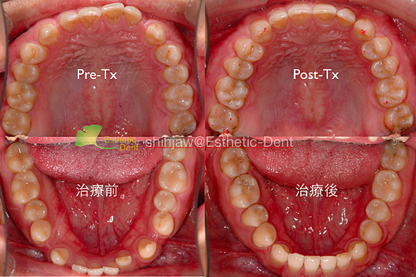 anterior-Xbite-invisalign-occlusal