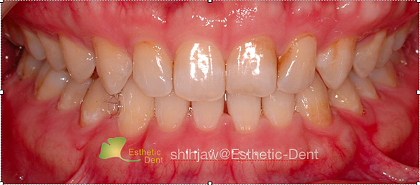 anterior-Xbite-invisalign-frontal