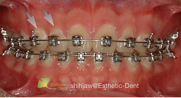 蔡士棹醫師的牙齒美容終極指南dr J S Ultimate Guide To Esthetic Dentistry 痞客邦 蔡士棹醫師的牙齒美容終極指南dr J S Ultimate Guide To Esthetic Dentistry 痞客邦