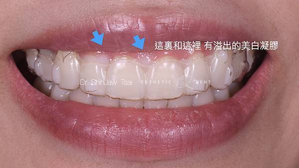 invisalign_whitening.003