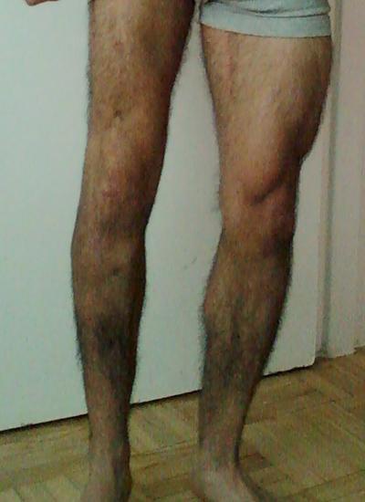 atrophy.jpg atrophy.jpg