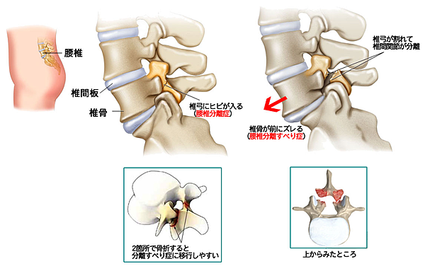 腰椎滑脫介紹 信誠徒手訓練舘 痞客邦