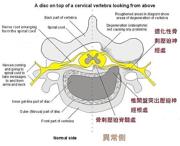 Cervial-radiculopathy-2.jpg