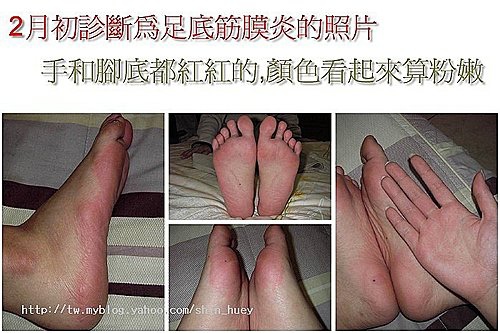 你到底有什麼毛病 乾癬 深夜寂寞的檸檬 痞客邦 你到底有什麼毛病 乾癬 深夜寂寞的檸檬 痞客邦