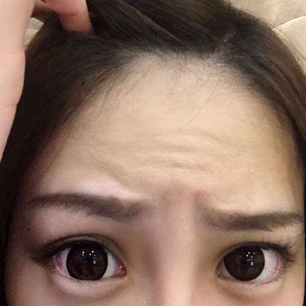 肉毒桿菌 人生沒有你要怎麼辦之肉毒桿菌消皺紋 小確幸診所官方部落格 痞客邦