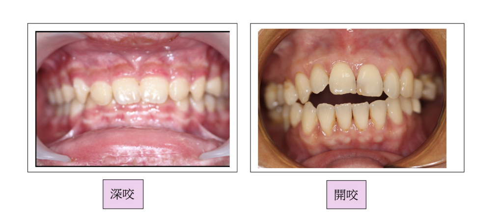 「牙齒矯正」牙齒矯正需要多久時間？高雄牙醫推薦