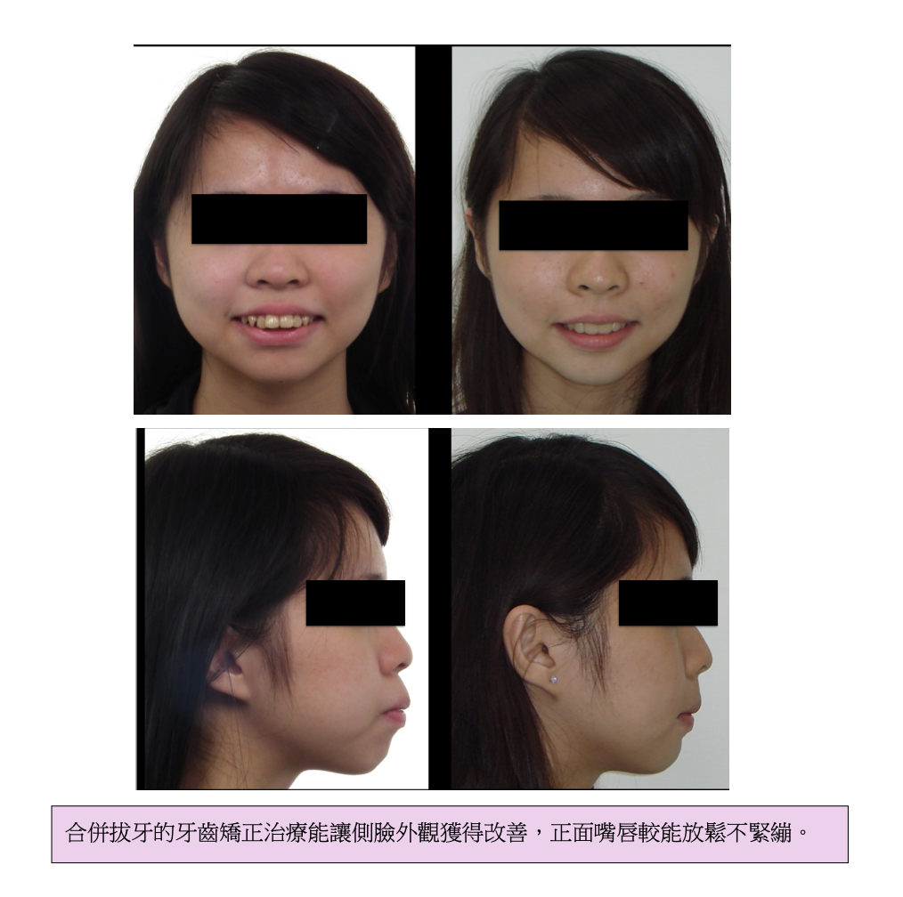 「牙齒矯正」牙齒矯正可以讓臉變小嗎？高雄牙醫推薦