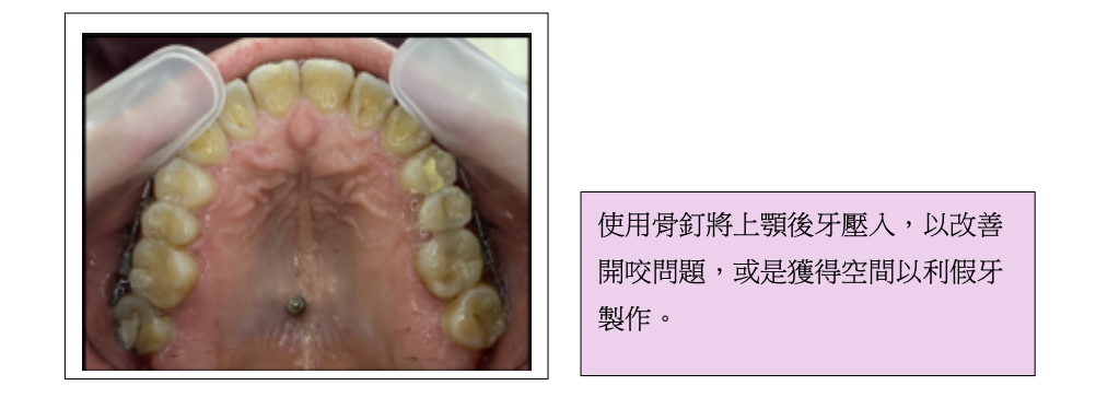 「牙齒矯正」一定要打骨釘嗎？會不會很痛？高雄牙醫推薦