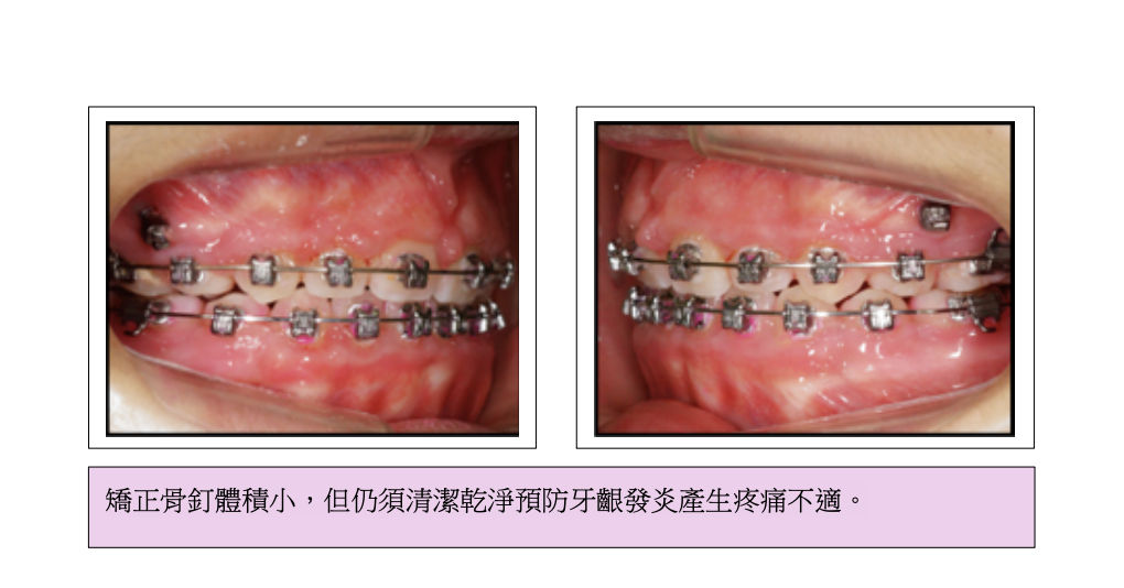 「牙齒矯正」一定要打骨釘嗎?會不會很痛?高雄牙醫推薦 「牙齒矯正」一定要打骨釘嗎?會不會很痛?高雄牙醫推薦
