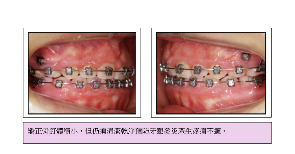 「牙齒矯正」一定要打骨釘嗎？會不會很痛？