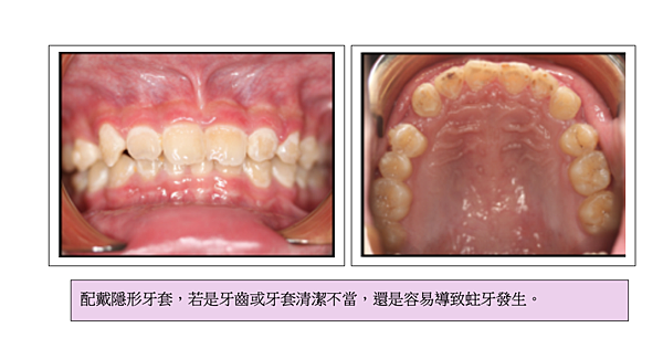 「牙齒矯正」牙齒矯正是不是會很容易蛀牙？