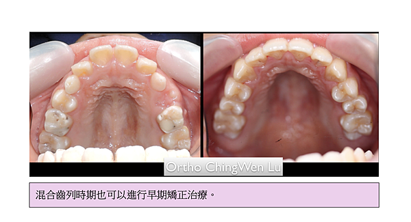 「牙齒矯正」一定要等全部恆牙長好才能牙齒矯正嗎？