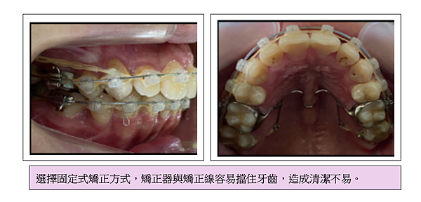 「牙齒矯正」牙齒矯正完牙齦會萎縮嗎？