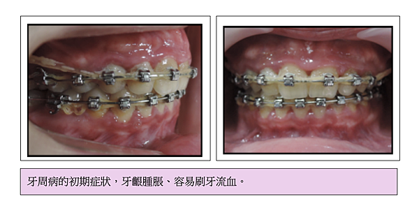 「牙齒矯正」牙齒矯正完牙齦會萎縮嗎？