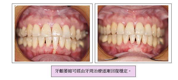 「牙齒矯正」牙齒矯正完牙齦會萎縮嗎？