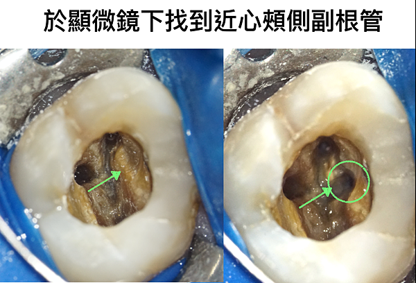 「顯微根管治療」顯微根管與一般根管的差別？高雄牙醫/左營牙醫/牙醫推薦