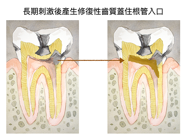 「顯微根管治療」顯微根管的適應症？高雄牙醫/左營牙醫/牙醫推薦