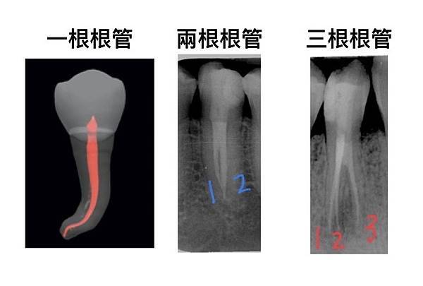「顯微根管治療」顯微根管的適應症？高雄牙醫/左營牙醫/牙醫推薦