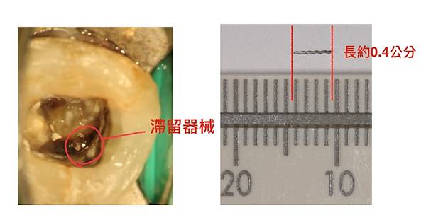 「顯微根管治療」顯微根管的適應症？