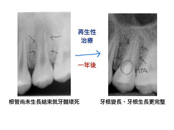 「顯微根管治療」顯微根管的適應症？高雄牙醫/左營牙醫/牙醫推薦