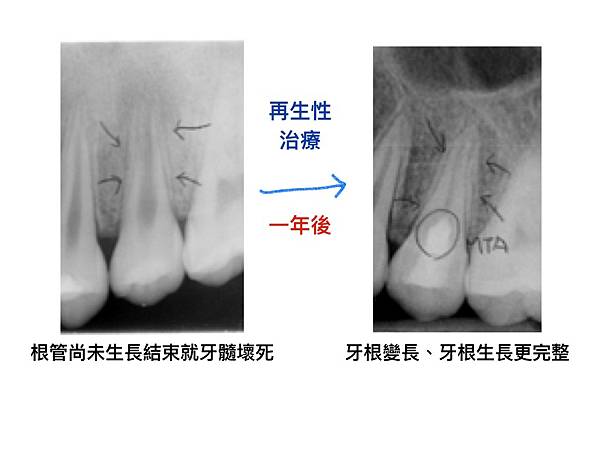 牙隨壞死.jpg