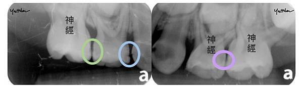 「兒童牙科」一定要拍X光嗎？拍這麼多X光沒問題嗎？高雄牙醫/左營牙醫/牙醫推薦