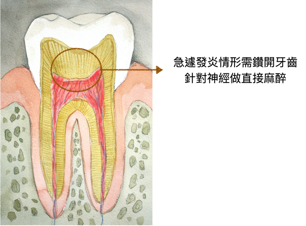 「顯微根管治療」顯微根管會不會痛？高雄牙醫/左營牙醫/牙醫推薦