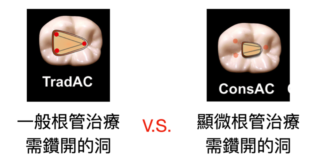 「顯微根管治療」我有一定要做顯微根管嗎？高雄牙醫/左營牙醫/牙醫推薦