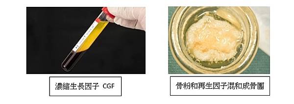 「植牙再生因子補骨」植牙再生因子補骨是什麼?