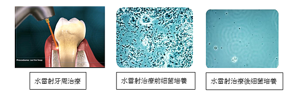 「水雷射治療」什麼是水雷射 ?高雄牙醫/左營牙醫/牙醫推薦 「水雷射治療」什麼是水雷射 ?高雄牙醫/左營牙醫/牙醫推薦