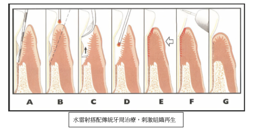 「水雷射治療」水雷射和傳統牙周治療哪個效果好？