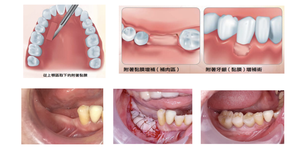 「植牙補牙肉治療」什麼是補牙肉?
