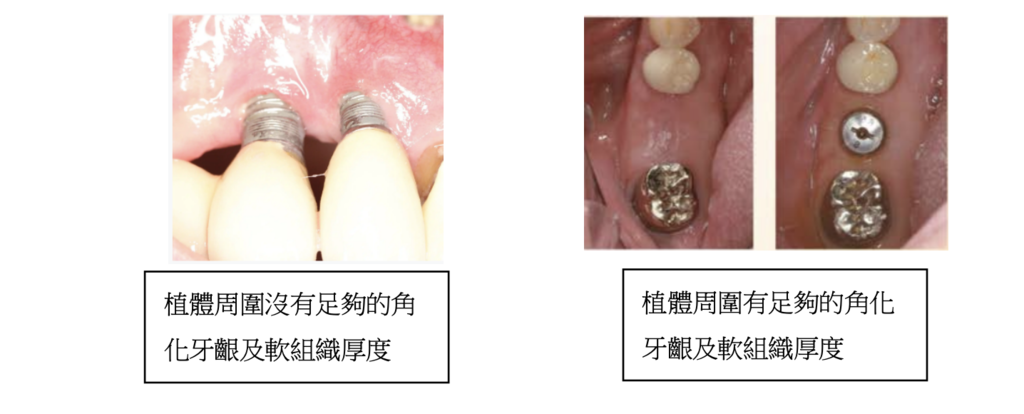 「植牙補牙肉治療」植牙為何要補牙肉，不補肉有什麼影響