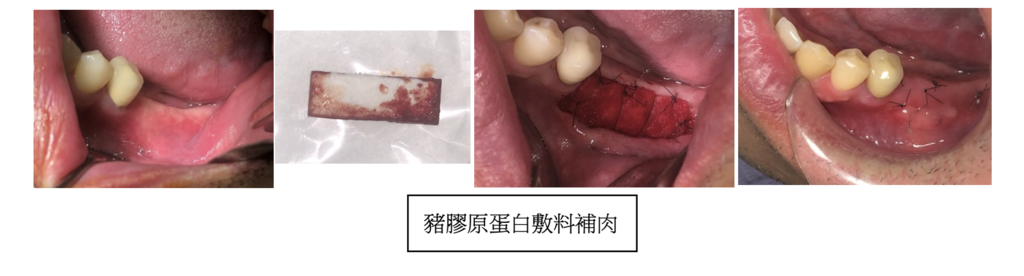 「植牙補牙肉治療」補牙肉通常從哪裡取，補牙肉一定要用自己的肉