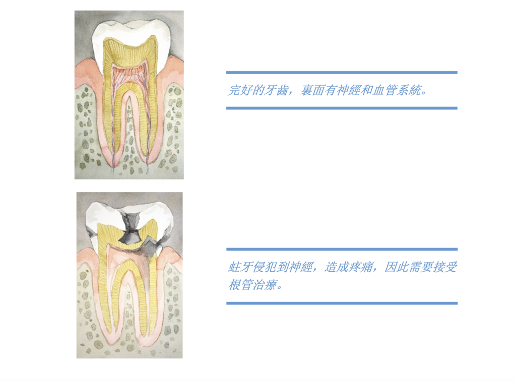 「兒童牙科」乳牙是否可以進行根管治療？高雄牙醫/左營牙醫/牙醫推薦