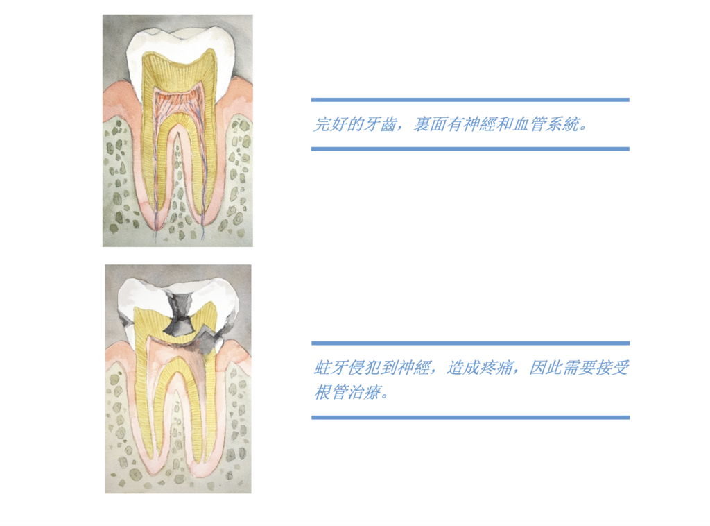 「兒童牙科」乳牙是否可以進行根管治療？