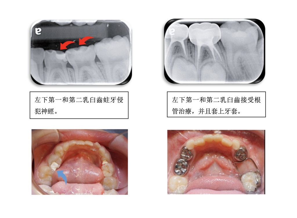 「兒童牙科」乳牙是否可以進行根管治療？高雄牙醫/左營牙醫/牙醫推薦