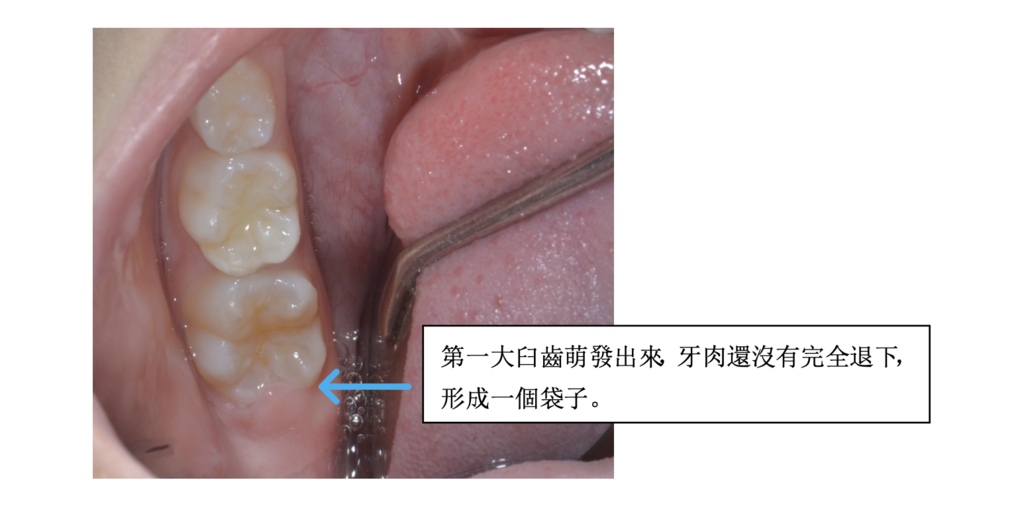 「兒童牙科」小朋友覺得最後方的牙齦腫，怎麼辦?