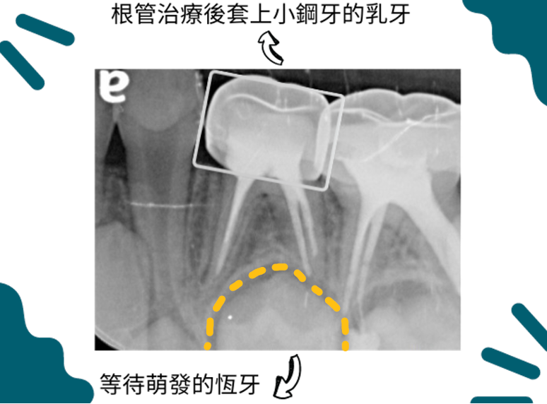 小鋼牙.png