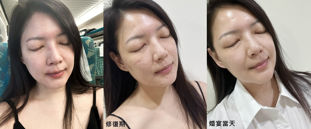 我的婚宴前保養【水光針】聖宜診所站前店