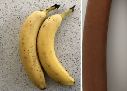 便秘變成小便失禁 為什麼？ Constipation tur