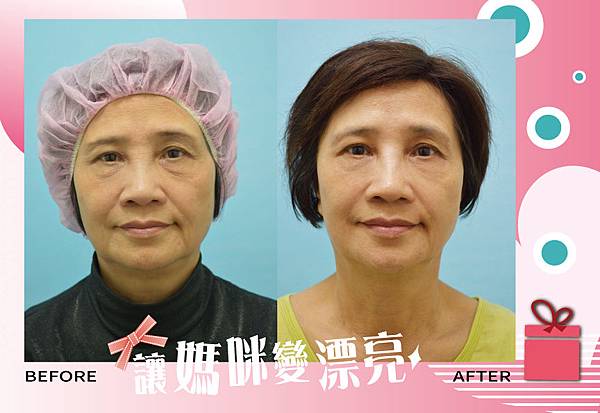 海芙音波拉提&波尿酸超保濕導入 海芙音波拉提&波尿酸超保濕導入