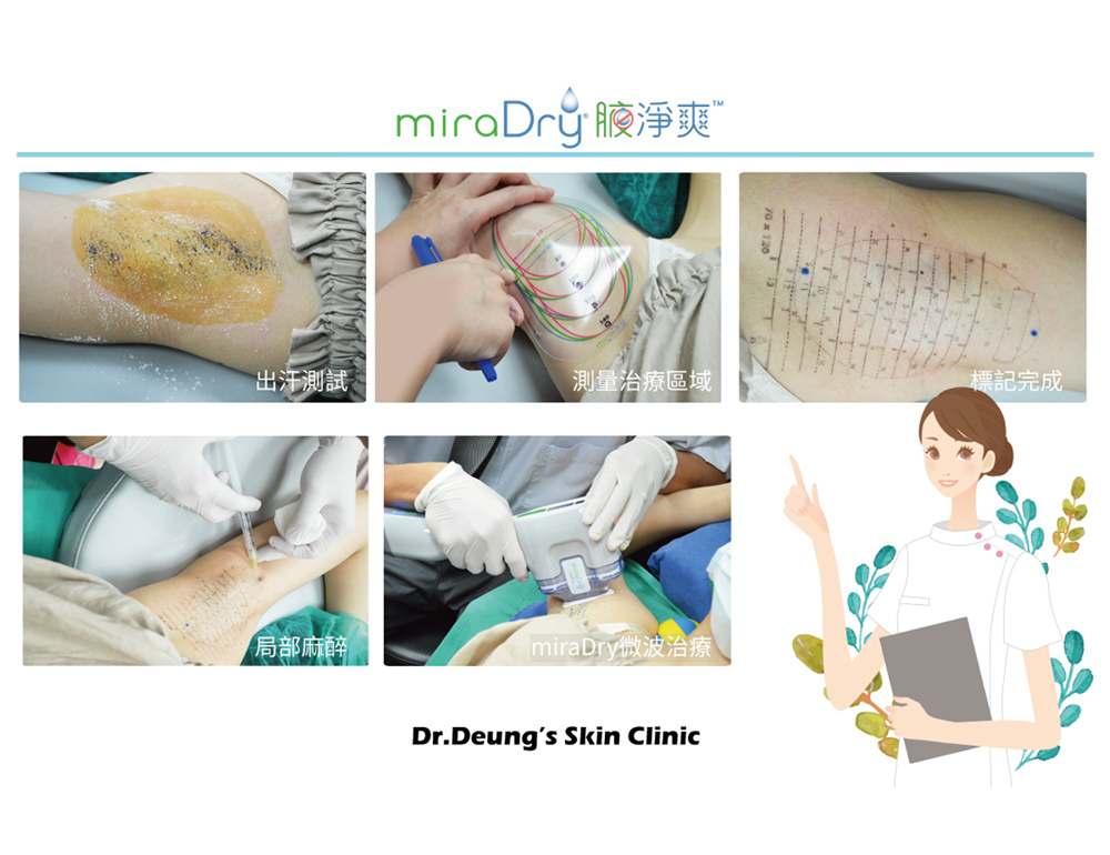 miradry腋淨爽療程解說