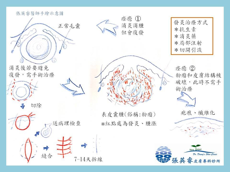 粉瘤手術 粉瘤手術