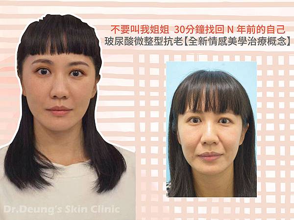FB不要叫我姐姐-玻尿酸微整抗老-張英睿.jpg FB不要叫我姐姐-玻尿酸微整抗老-張英睿.jpg