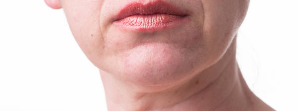 wrinkles on the neck.png