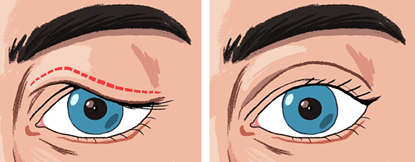 Sagging eyelids.png Sagging eyelids.png